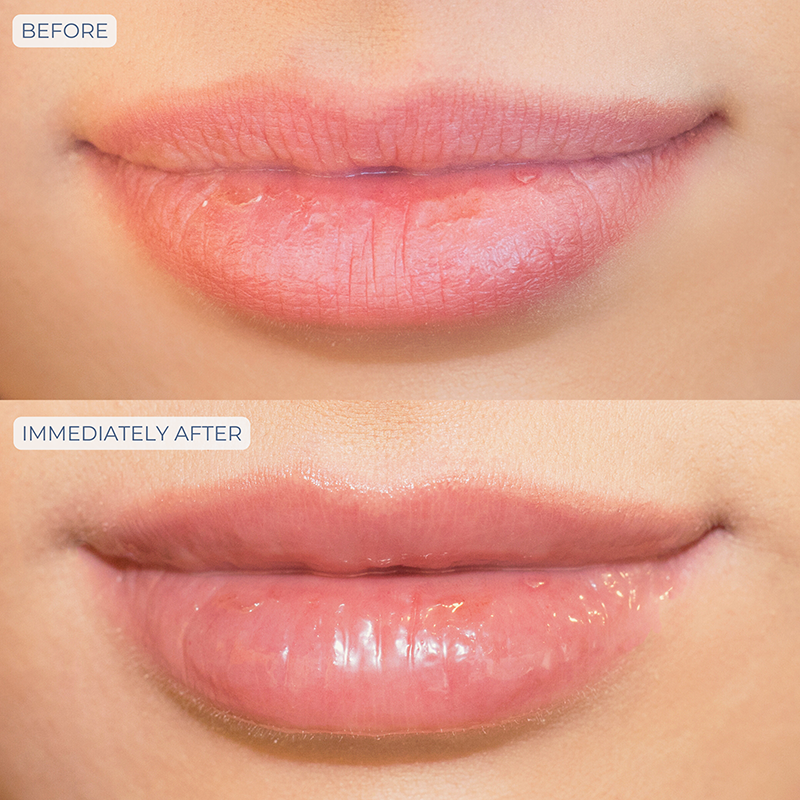 Tri-Liptide peptide lip enhancing treatment .5oz/15ml before and after