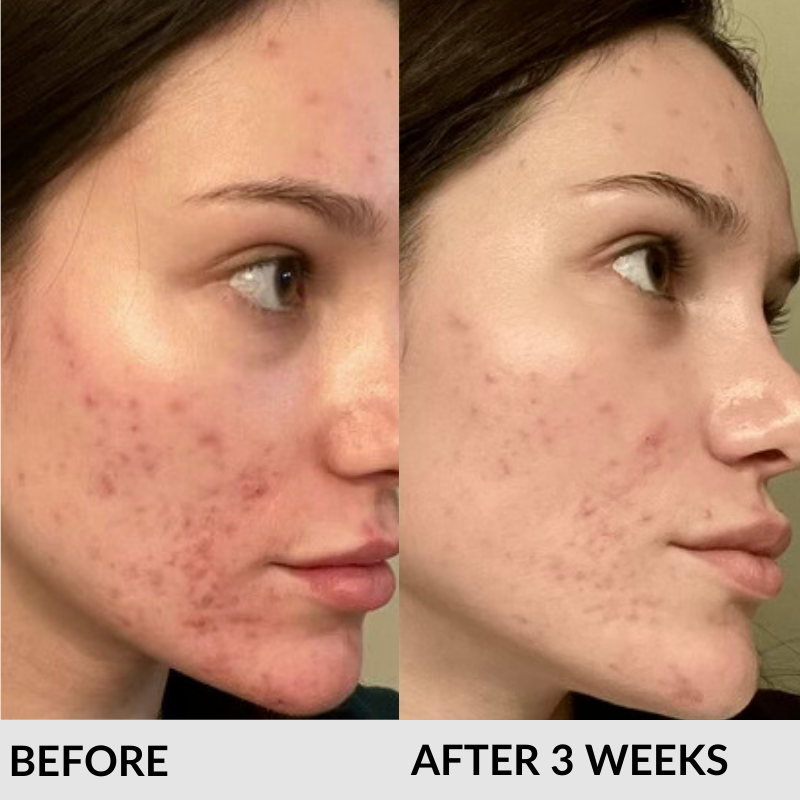 Ao2 Skin Oxygen Nanobubble Skin Therapy - 30 Day Supply - RegimenPro®