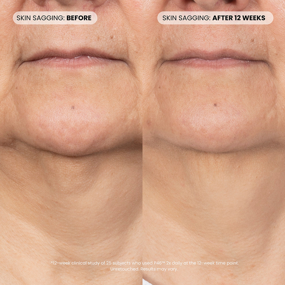 Dr. Whitney Bowe Beauty P46 Refill before and after - skin sagging reduction after 12 weeks