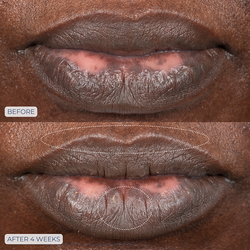 Tri-Liptide peptide lip enhancing treatment .5oz/15ml before and after