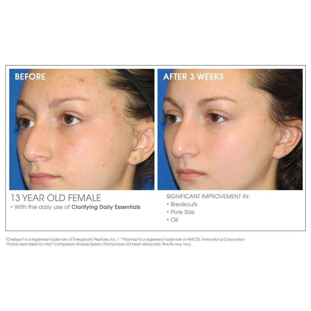 Before and after on 13 year old female using Glowbiotics skincare Clarifying + Refining Serum 