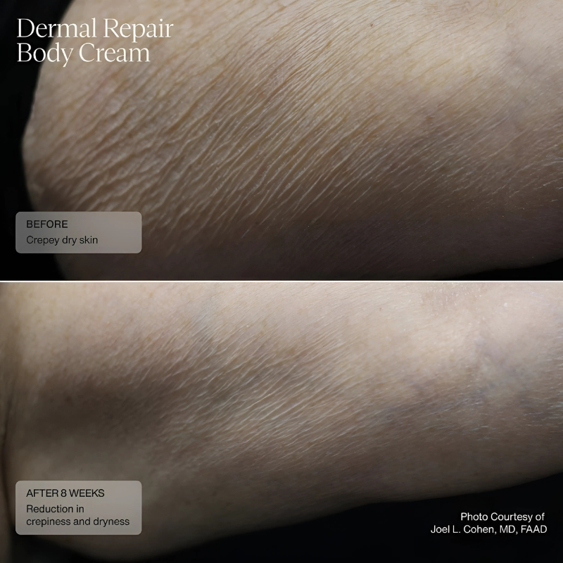 Sente Dermal Repair Body Cream 177.4 ml / 6 US fl oz before and after