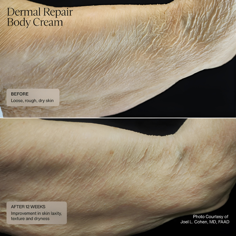 Sente Dermal Repair Body Cream 177.4 ml / 6 US fl oz results before and after