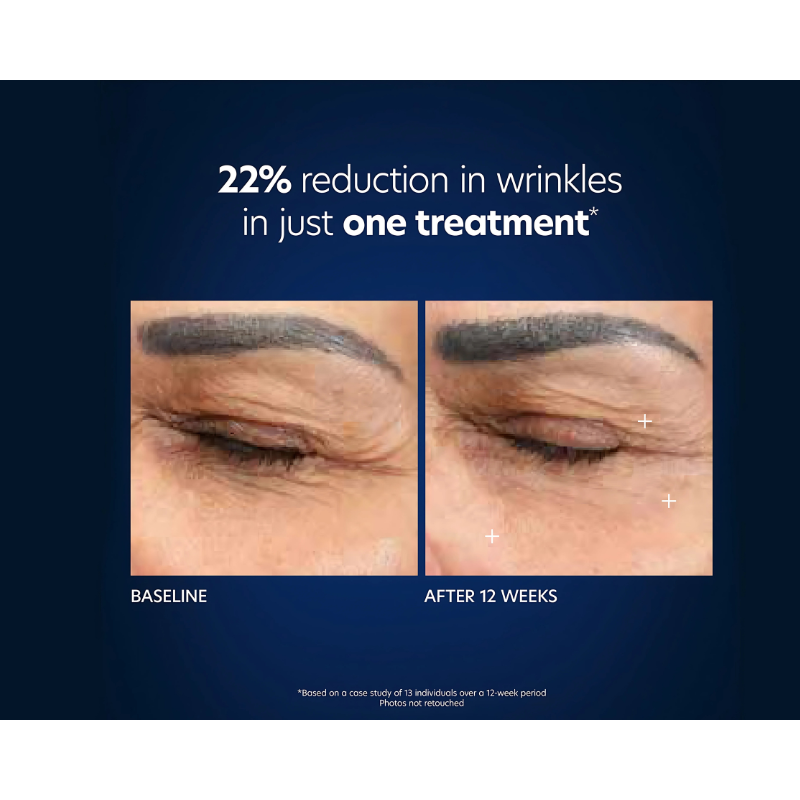 PCA skin Hyaluronic Acid Microneedle Eye Patch 4 treatments before and after 12 weeks