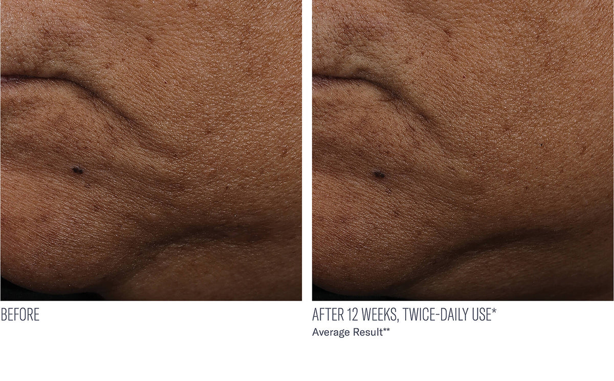 Interfuse Treatment Cream FACE and NECK before and after, 12 weeks