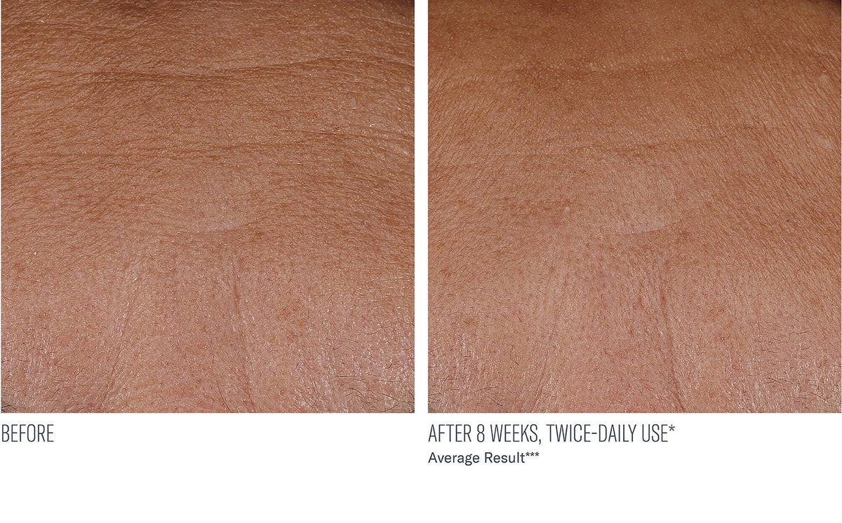 Interfuse Treatment Cream FACE and NECK before and after, 8 weeks