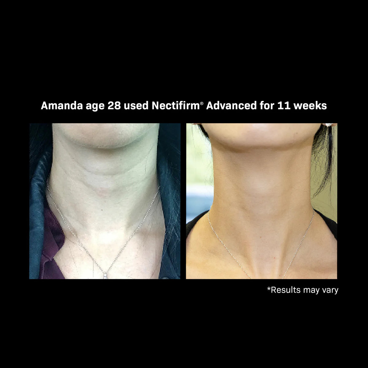 Revision Skincare Nectifirm Advanced before and after on woman age 28