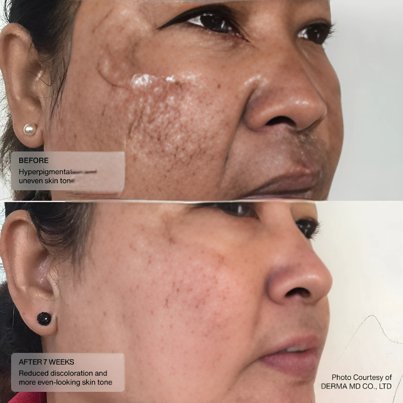 Sente Even Tone Retinol Cream 30 ml / 1 US fl oz hyperpigmentation result before and after