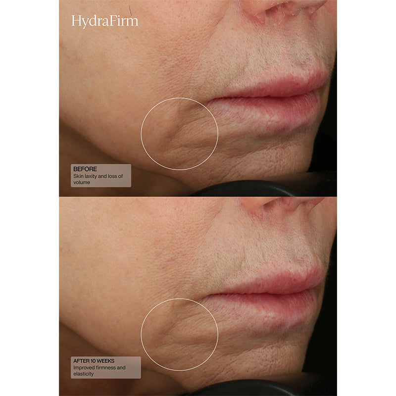 Sente HydraFirm serum 30 ml / 1 US fl oz before and after 10 weeks