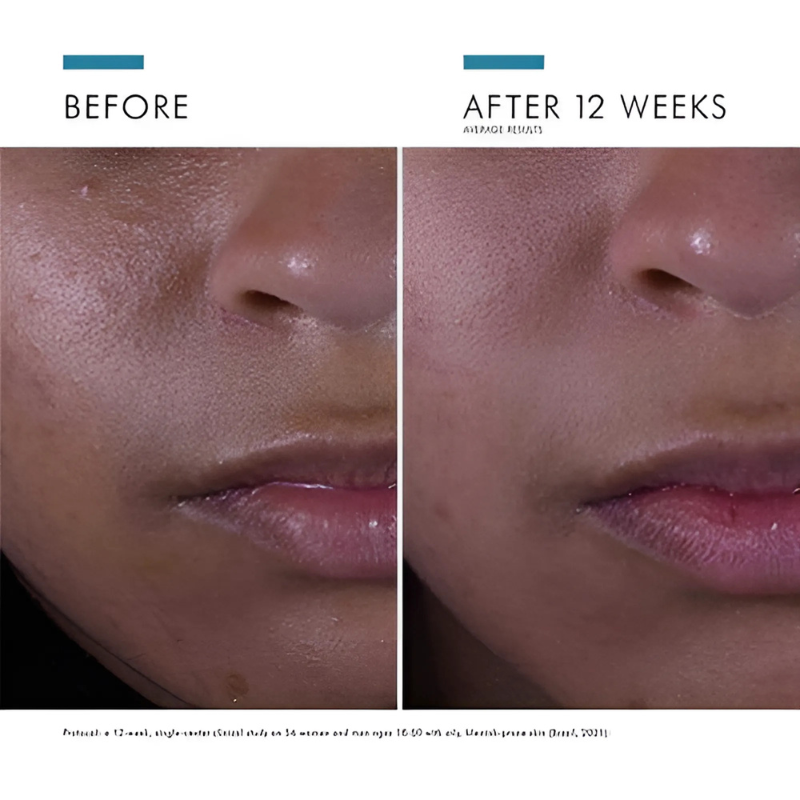 SkinCeuticals Silymarin CF 30 ml / 1 fl oz before and after 12 weeks 