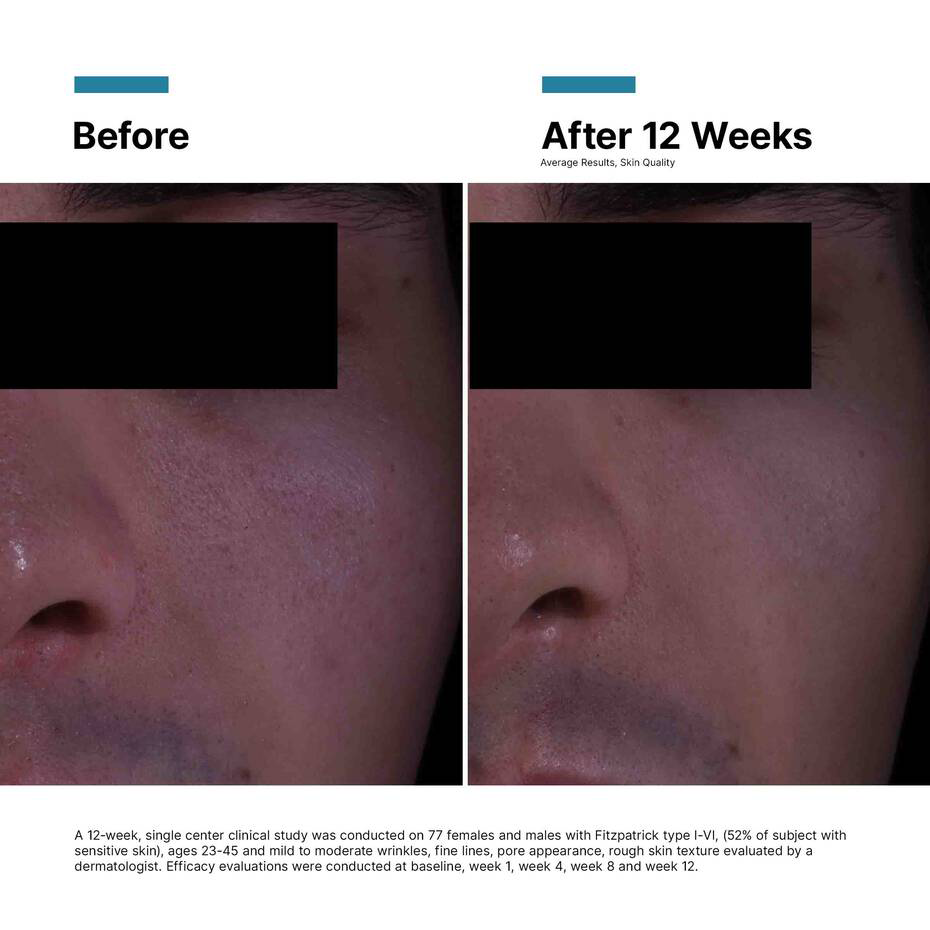 SkinCeuticals P-TIOX Wrinkle-Modulating Peptide Cream. Before and after 12 weeks 