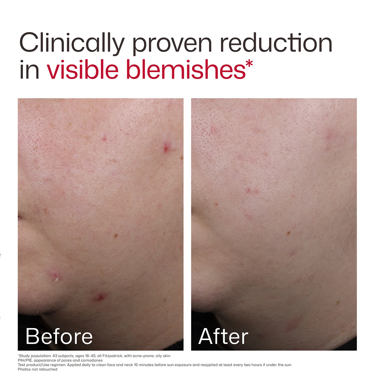 EltaMD UV Clear Blemish-Prone & Oil Balancing Broad Spectrum SPF 50. 1.7oz/48g size before and after 