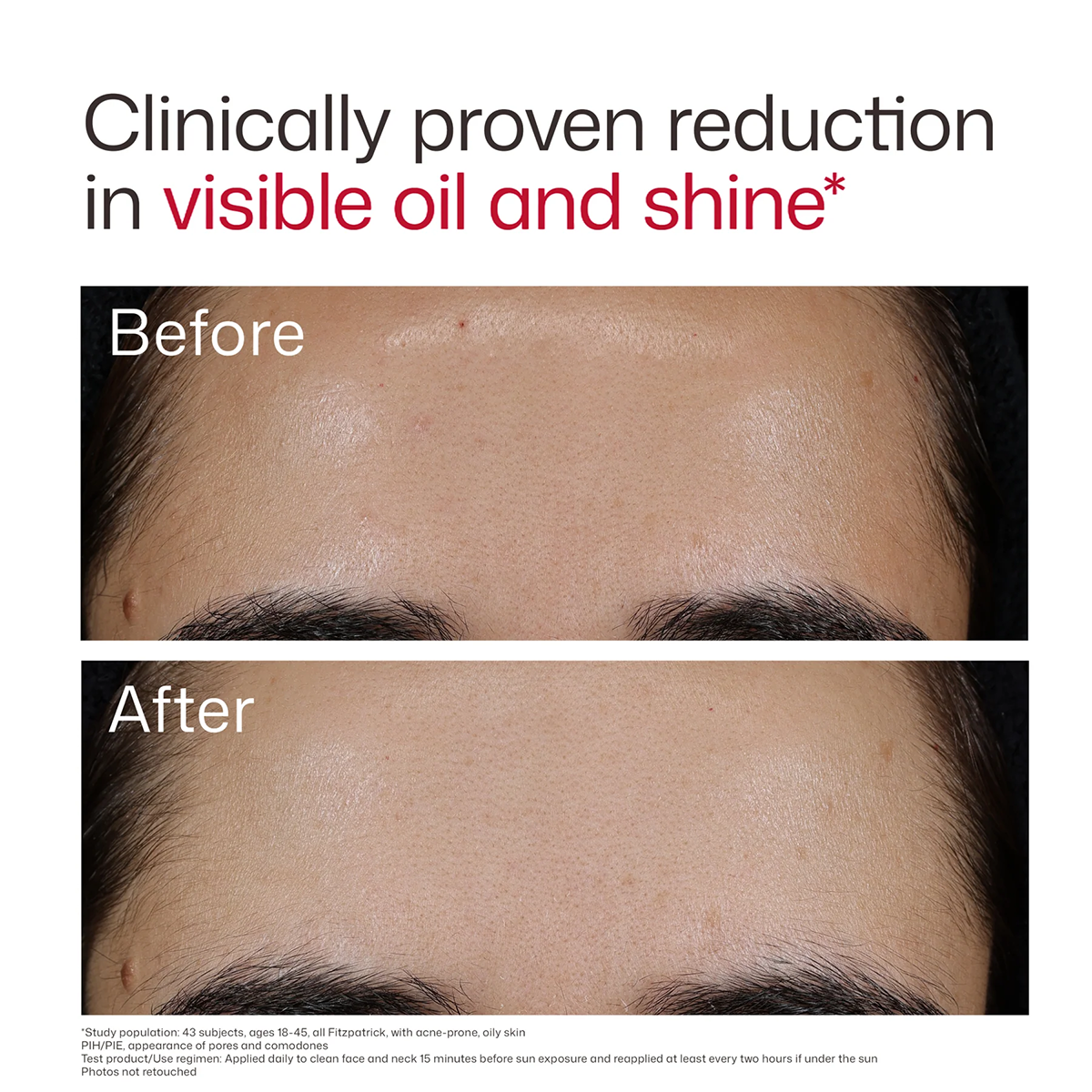 EltaMD UV Clear Blemish-Prone & Oil Balancing Broad Spectrum SPF 50. 1.7oz/48g size before & after 2