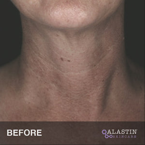 Restorative Neck Complex before and after video