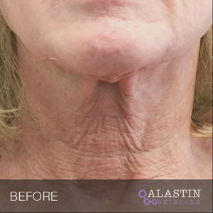 Restorative Neck Complex before and after video