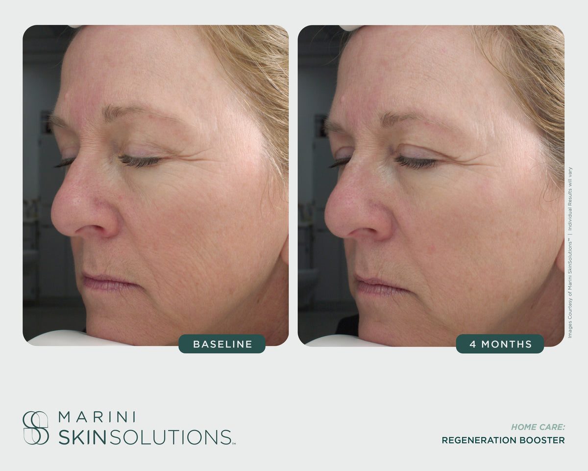 Marini Skin Solutions 4 months before and after using Regeneration Booster