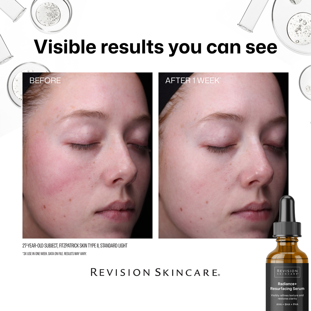 Revision Skincare Radiance+ Resurfacing Serum before and after, 1 week time 