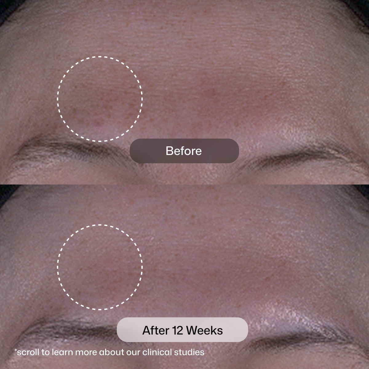 Revision Skincare Tone+ Correcting Pads before and after 12 weeks